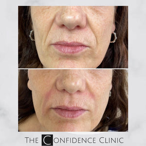 Natural results from dermal filler treatment to cheeks and nasolabial folds