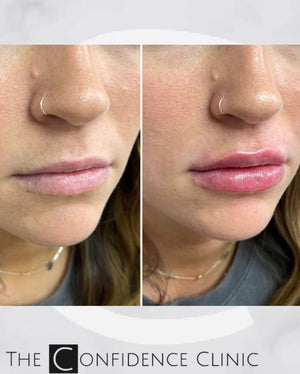 1ml first time lip augmentation