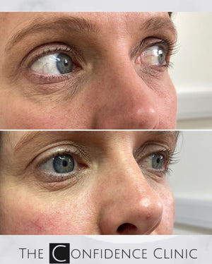 Brightening up those under eyes with dermal filler