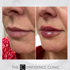 Building up the lips with 0.5 ml enhancement