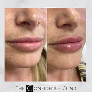 Lip enhancement