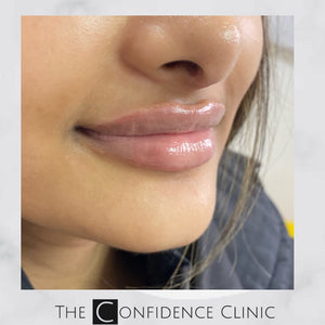 Gorgeous 0.5 ml lip enhancement with dermal filler