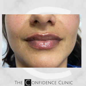 Lovely 0.6ml lip enhancement