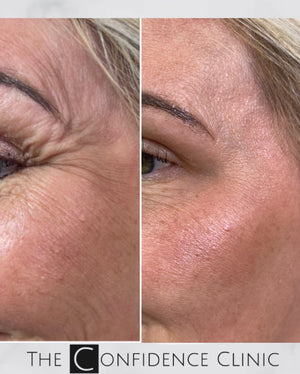Amazing results from anti-wrinkle treatment
