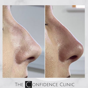 Non surgical rhinoplasty(nose job)