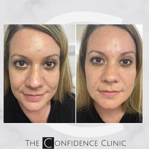 Fabulous results from just a small amount of filler in the cheeks and nasolabial folds