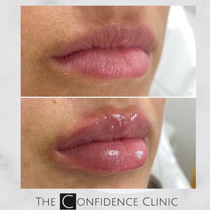 Gorgeous 1ml lip enhancement