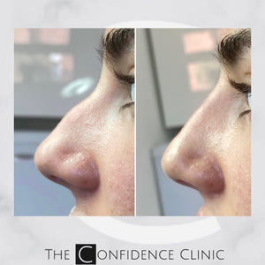 Before and immediately after a non surgical rhinoplasty (nose job)