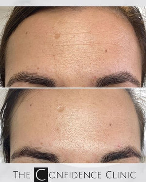 Fantastic softening of static (without movement) and dynamic (with movement) lines with anti-wrinkle injections