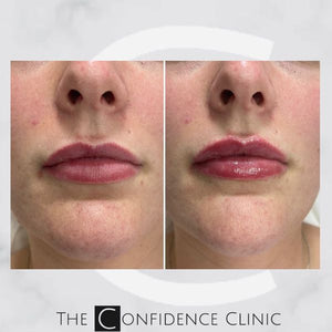 Lovely 0.5ml lip enhancement