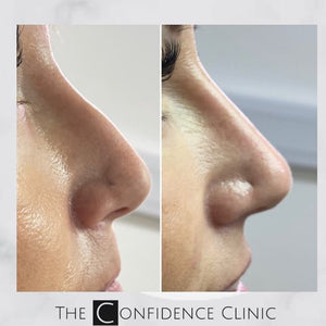 Non surgical rhinoplasty before and after