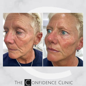 The power of a small amount of mid-face filler