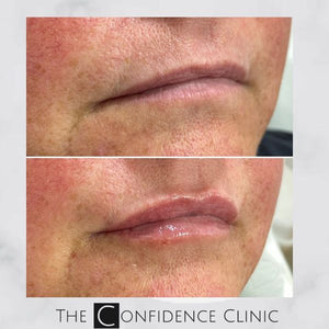 Small amount of dermal filler