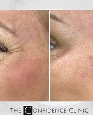 Smoothing out those crows feet