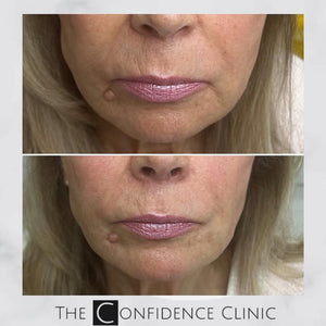 Lovely natural results to treating the lower face with dermal filler. 
You can see how immediatel...