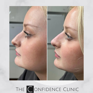 A small change can make a HUGE difference to your confidence 😍

Using dermal filler to straighten...