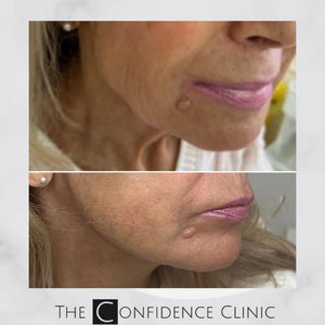 The magic of Radiesse ✨ 
This lady was mainly concerned about the skin laxity in her lower face b...